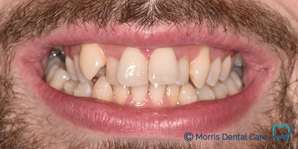 Before treatment the patient had crowded teeth which inhibited good oral care (teeth cleaning)